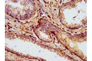 IHC image of ABIN7144958 diluted at 1:500 and staining in paraffin-embedded human prostate cancer performed on a Leica BondTM system.