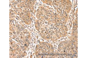 Immunohistochemistry of Human lung cancer using PDLIM4 Polyclonal Antibody at dilution of 1:40 (PDLIM4 anticorps)