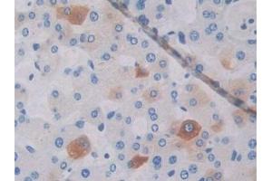 Detection of ABCA1 in Human Liver cancer Tissue using Polyclonal Antibody to ATP Binding Cassette Transporter A1 (ABCA1)