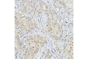Immunohistochemistry of paraffin-embedded human breast cancer using MMP3 Rabbit pAb (ABIN3021708, ABIN3021709, ABIN3021710 and ABIN6215578) at dilution of 1:200 (40x lens).