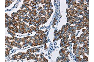 IHC analysis of paraffin-embedded human breast cancer tissue, using HINT2 antibody (1/50 dilution, 200X magnification). (HINT2 anticorps)