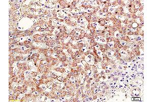 Formalin-fixed and paraffin embedded human cervical carcinoma labeled with Anti-RAR Beta Polyclonal Antibody (ABIN669516), Unconjugated at 1:400, followed by conjugation to the secondary antibody and DAB staining