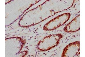 IHC image of ABIN7127380 diluted at 1:118 and staining in paraffin-embedded human gastric cancer performed on a Leica BondTM system.