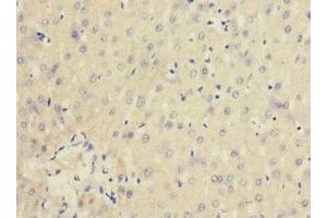 Immunohistochemistry of paraffin-embedded human liver cancer using ABIN7156847 at dilution of 1:100