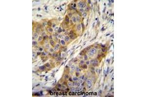 ANR39 Antibody (C-term) immunohistochemistry analysis in formalin fixed and paraffin embedded human breast carcinoma followed by peroxidase conjugation of the secondary antibody and DAB staining. (ANKRD39 anticorps  (C-Term))