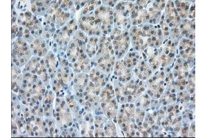 Immunohistochemical staining of paraffin-embedded Adenocarcinoma of Human colon tissue using anti-MIOX mouse monoclonal antibody. (MIOX anticorps)