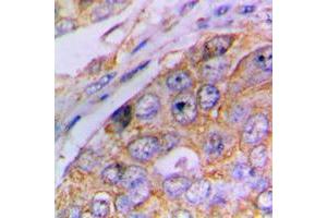 Immunohistochemical analysis of Caspase 4 p20 staining in human lung cancer formalin fixed paraffin embedded tissue section. (Caspase 4 p20 (Center) anticorps)