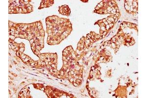 IHC image of ABIN7146454 diluted at 1:200 and staining in paraffin-embedded human prostate cancer performed on a Leica BondTM system. (Calcyphosine anticorps  (AA 1-189))