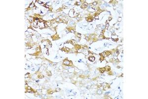 Immunohistochemistry of paraffin-embedded human liver cancer using Alpha-1 Antichymotrypsin (Alpha-1 Antichymotrypsin (SERPIN)) antibody (ABIN3016733, ABIN3016734, ABIN3016735 and ABIN6219829) at dilution of 1:100 (40x lens).