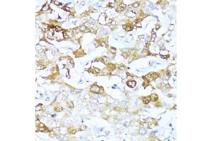 Immunohistochemistry of paraffin-embedded human liver cancer using Alpha-1 Antichymotrypsin (Alpha-1 Antichymotrypsin (SERPIN)) antibody (ABIN3016733, ABIN3016734, ABIN3016735 and ABIN6219829) at dilution of 1:100 (40x lens). (SERPINA3 anticorps  (AA 24-423))