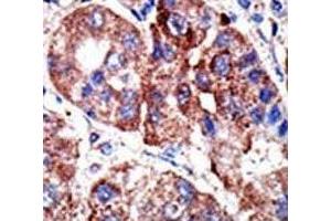 IHC analysis of FFPE human hepatocarcinoma tissue stained with the p62 antibody