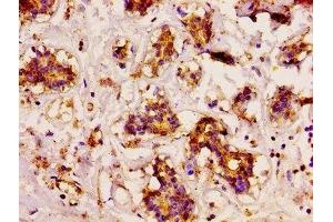 IHC image of ABIN7150414 diluted at 1:200 and staining in paraffin-embedded human breast cancer performed on a Leica BondTM system. (CD3EAP anticorps  (AA 289-404))