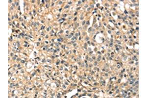 The image on the left is immunohistochemistry of paraffin-embedded Human breast cancer tissue using ABIN7131243(STX8 Antibody) at dilution 1/35, on the right is treated with fusion protein. (STX8 anticorps)