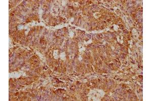 IHC image of ABIN7170987 diluted at 1:500 and staining in paraffin-embedded human colon cancer performed on a Leica BondTM system.