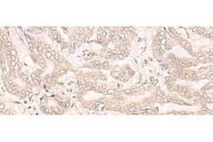 Immunohistochemistry of paraffin-embedded Human liver cancer tissue using ENO4 Polyclonal Antibody at dilution of 1:30(x200) (ENO4 anticorps)