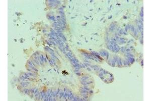 Immunohistochemistry of paraffin-embedded human colon cancer using ABIN7156372 at dilution of 1:100 (IGFBP4 anticorps  (AA 22-258))
