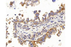 Immunohistochemistry analysis of paraffin-embedded human lung cancer using PERK Polyclonal Antibody at dilution of 1:400. (PERK anticorps)