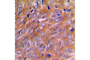 Immunohistochemical analysis of BNIP2 staining in human breast cancer formalin fixed paraffin embedded tissue section.