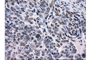 Immunohistochemical staining of paraffin-embedded Adenocarcinoma of colon tissue using anti-RPA2 mouse monoclonal antibody. (RPA2 anticorps)