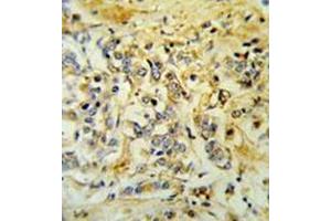 Immunohistochemistry analysis in formalin fixed and paraffin embedded breast carcinoma reacted with LMBR1L Antibody (C-term) followed which was peroxidase conjugated to the secondary antibody and followed by DAB staining. (LMBR1L anticorps  (C-Term))