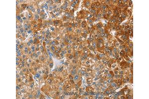 Immunohistochemistry of Human thyroid cancer using CD200R1 Polyclonal Antibody at dilution of 1:60 (HCRTR2 anticorps)