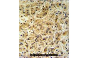 GNS Antibody (Center N189) IHC analysis in formalin fixed and paraffin embedded human hepatocarcinoma followed by peroxidase conjugation of the secondary antibody and DAB staining. (GNS anticorps  (AA 174-203))