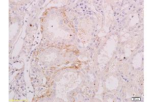 Formalin-fixed and paraffin embedded human renal carcinoma labeled with Anti-BAFFR/CD268 Polyclonal Antibody, Unconjugated (ABIN740760) at 1:200 followed by conjugation to the secondary antibody (TNFRSF13C anticorps  (AA 121-184))