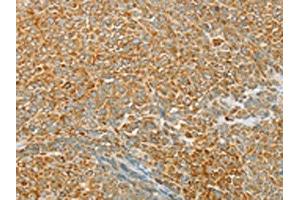 The image on the left is immunohistochemistry of paraffin-embedded Human ovarian cancer tissue using ABIN7130771(PTPN22 Antibody) at dilution 1/20, on the right is treated with fusion protein.