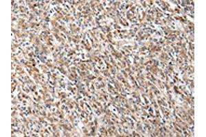The image on the left is immunohistochemistry of paraffin-embedded Human gastric cancer tissue using ABIN7130604(PGRMC2 Antibody) at dilution 1/20, on the right is treated with fusion protein.