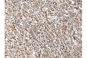 The image on the left is immunohistochemistry of paraffin-embedded Human gastric cancer tissue using ABIN7130604(PGRMC2 Antibody) at dilution 1/20, on the right is treated with fusion protein. (PGRMC2 anticorps)