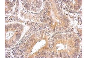 IHC-P Image RRM1 antibody detects RRM1 protein on human gastric cancer by immunohistochemical analysis. (RRM1 anticorps  (Center))