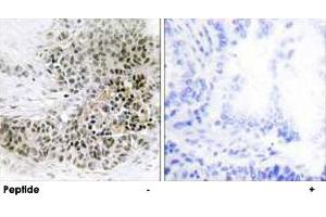 Immunohistochemistry analysis of paraffin-embedded human lung carcinoma tissue, using TRPS1 polyclonal antibody . (TRPS1 anticorps  (AA 121-170))
