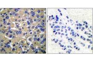 Immunohistochemistry analysis of paraffin-embedded human breast carcinoma tissue, using WNK1 (Ab-58) Antibody. (WNK1 anticorps  (AA 24-73))