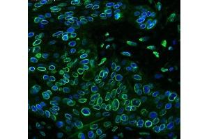 IF analysis of Emerin using anti-Emerin antibody (ABIN4886569) Emerin was detected in paraffin-embedded section of human oesophagus squama cancer tissues. (Emerin anticorps  (N-Term))