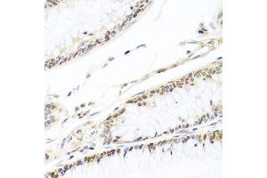 Immunohistochemistry of paraffin-embedded human colon carcinoma using HIRA antibody.