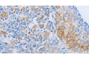 Immunohistochemistry of paraffin-embedded Human cervical cancer tissue using ADRB3 Polyclonal Antibody at dilution 1:60 (ADRB3 anticorps)
