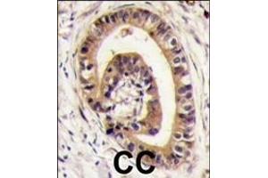 Formalin-fixed and paraffin-embedded human colon carcinoma tissue reacted with PIST antibody (C-term), which was peroxidase-conjugated to the secondary antibody, followed by DAB staining. (GOPC anticorps  (C-Term))