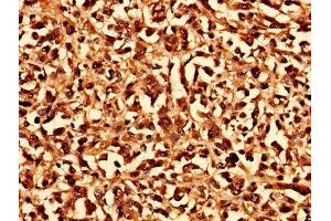 Immunohistochemistry analysis of human melanoma using ABIN7147533 at dilution of 1:100
