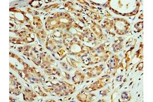 Immunohistochemistry of paraffin-embedded human breast cancer using ABIN7148496 at dilution of 1:100 (COPS4 anticorps  (AA 1-310))