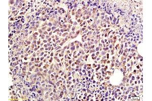 Formalin-fixed and paraffin-embedded mouse tumor labeled with Rabbit Anti-IDE Polyclonal Antibody, Unconjugated  at 1:300 followed by conjugation to the secondary antibody and DAB staining
