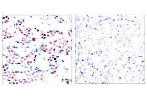 Immunohistochemical analysis of paraffin-embedded human breast carcinoma tissue using c-Jun(Phospho-Thr91) Antibody(left) or the same antibody preincubated with blocking peptide(right). (C-JUN anticorps  (pThr91))