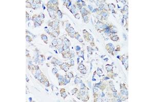 Immunohistochemistry of paraffin-embedded human breast cancer using Src antibody (ABIN6132240, ABIN6148428, ABIN6148429 and ABIN6215399) at dilution of 1:100 (40x lens).
