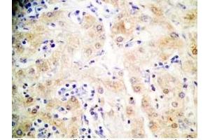 Human hepatocellular carcinoma tissue was stained by Rabbit Anti-FGF-21 (26-47) (H)