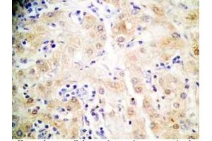 Human hepatocellular carcinoma tissue was stained by Rabbit Anti-FGF-21 (26-47) (H) (FGF21 anticorps  (AA 26-47))