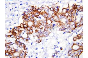 Anti-GCLC antibody, IHC(P) IHC(P): Human Rectal Cancer Tissue (GCLC anticorps  (N-Term))