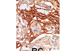 Formalin-fixed and paraffin-embedded human cancer tissue reacted with the primary antibody, which was peroxidase-conjugated to the secondary antibody, followed by AEC staining. (ARAF anticorps  (AA 256-286))