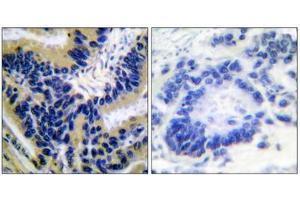 Immunohistochemical analysis of paraffin-embedded human lung carcinoma tissue, using Caspase 3 (cleaved-Asp175) antibody. (Caspase 3 anticorps  (Cleaved-Asp175))