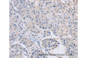 Immunohistochemistry of Human lung cancer using ABLIM1 Polyclonal Antibody at dilution of 1:30 (ABLIM1 anticorps)