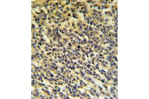 PLA2G6 Antibody (Center) (ABIN653895 and ABIN2843138) IHC analysis in formalin fixed and paraffin embedded testis carcinoma followed by peroxidase conjugation of the secondary antibody and DAB staining. (PLA2G6 anticorps  (AA 551-580))