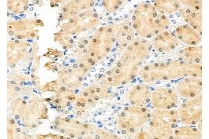 ABIN6264711 and ABIN6277609 at 1/100 staining Human gastric cancer by IHC-P.